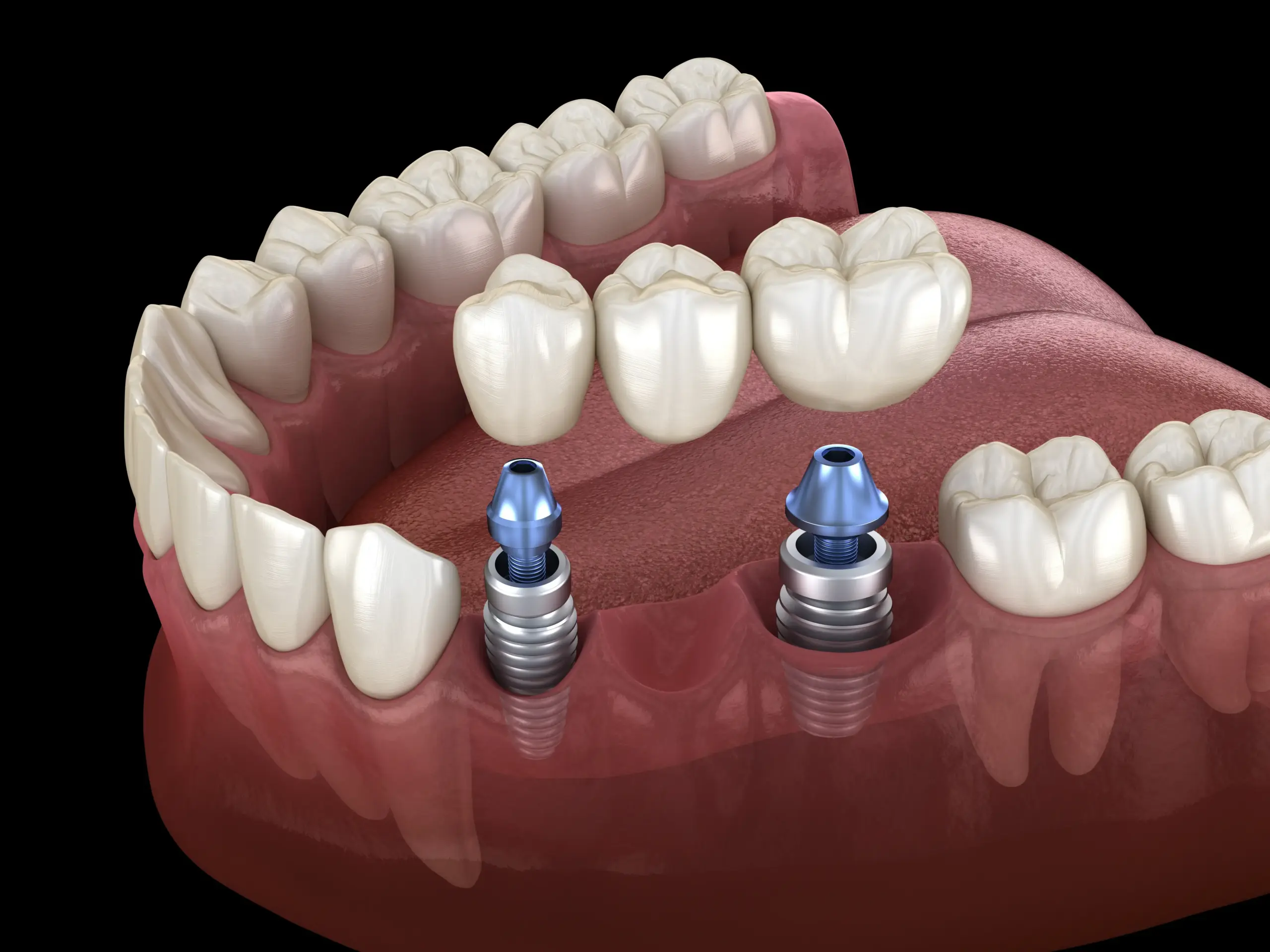Dental Implants vs. Bridges